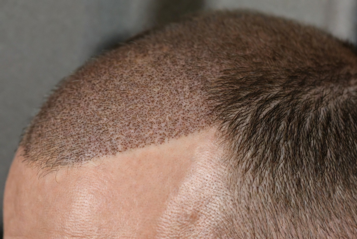 La tricopigmentation effet densité 2 cm après plusieurs greffes de cheveux